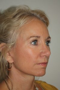 Female Facelift Patient 52 - After - 1 Thumbnail