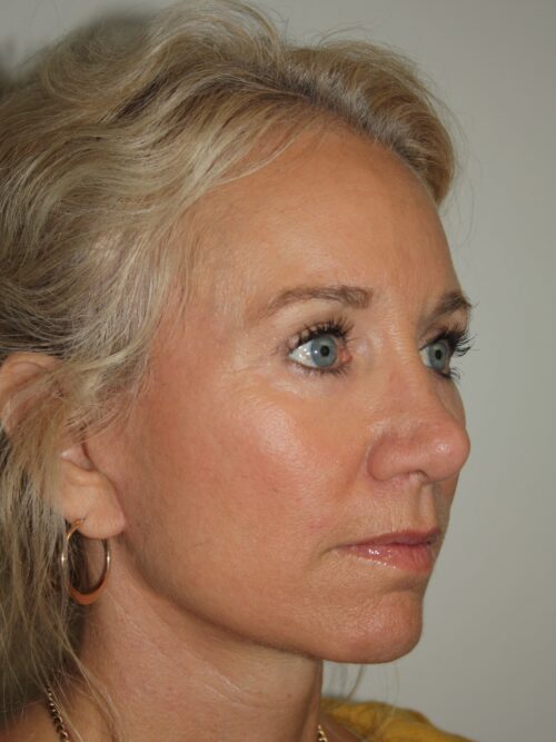 Female Facelift Patient 52 - After - 1