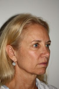 Female Facelift Patient 52 - Before - 1 Thumbnail