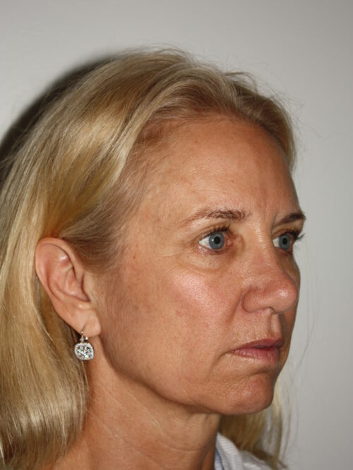 Female Facelift Patient 52 - Before - 1