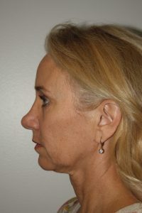 Female Facelift Patient 52 - Before - 3 Thumbnail