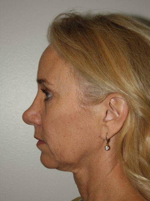 Female Facelift Patient 52 - Before - 3