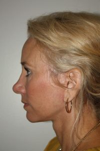 Female Facelift Patient 52 - After - 3 Thumbnail