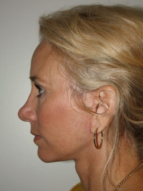 Female Facelift Patient 52 - After - 3