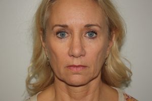 Female Facelift Patient 52 - Before - 2 Thumbnail