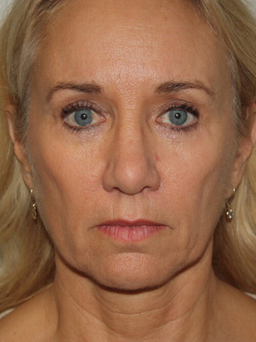 Female Facelift Patient 52 - Before - 2