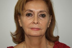 Female Facelift Patient 52 and Upper Lip Lift - Before - 2 Thumbnail