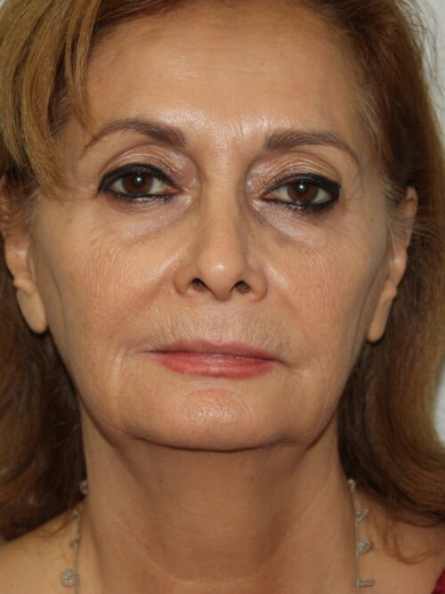 Female Facelift Patient 52 and Upper Lip Lift - Before - 2