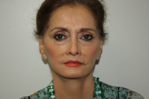 Female Facelift Patient 52 and Upper Lip Lift - After - 2 Thumbnail