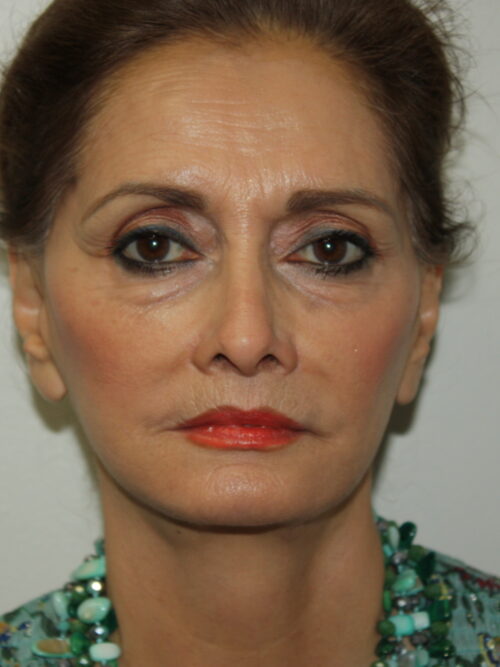 Female Facelift Patient 52 and Upper Lip Lift - After - 2