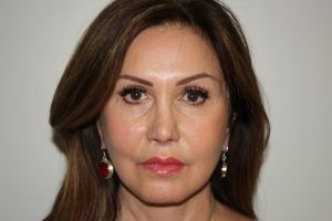 Female Facelift Patient 51 and Upper Lip Lift - After - 1 Thumbnail