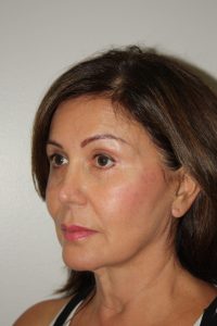 Female Facelift Patient 51 and Upper Lip Lift - Before - 3 Thumbnail