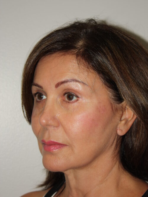 Female Facelift Patient 51 and Upper Lip Lift - Before - 3