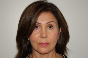 Female Facelift Patient 51 and Upper Lip Lift - Before - 1 Thumbnail