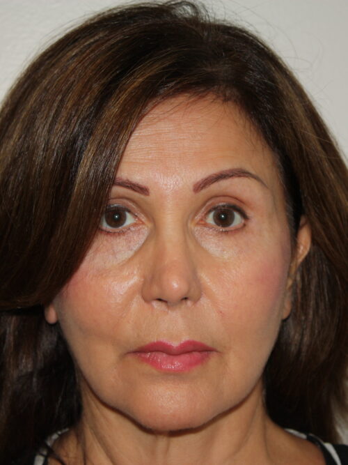 Female Facelift Patient 51 and Upper Lip Lift - Before - 1