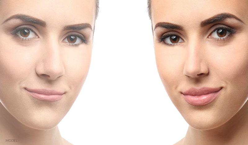 A woman's face before and after an upper lip lift.