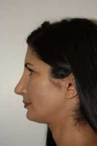 Rhinoplasty Patient 33 - After - 2 Thumbnail