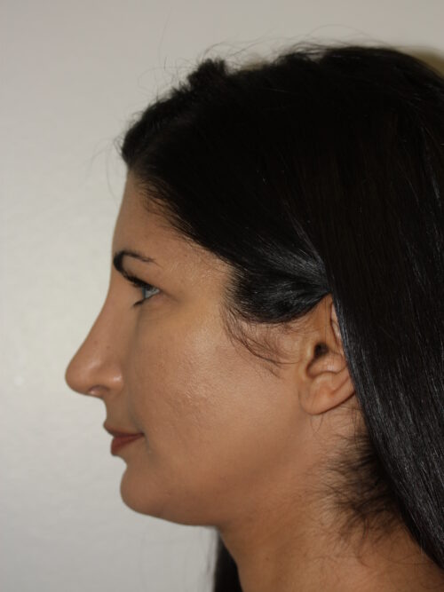 Rhinoplasty Patient 33 - After - 2