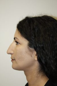 Rhinoplasty Patient 33 - Before - 2 Thumbnail