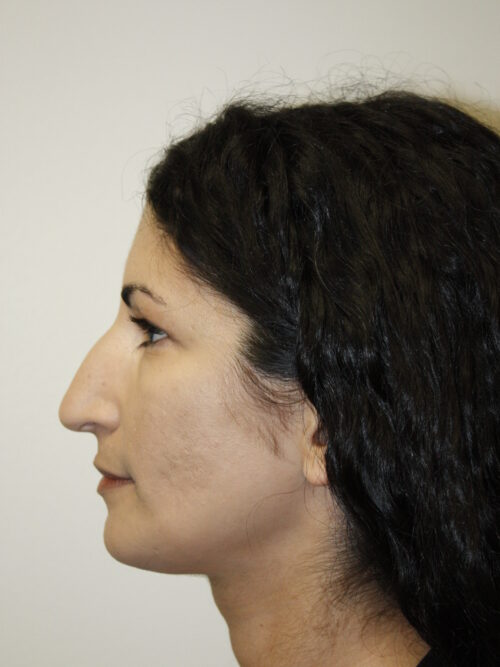 Rhinoplasty Patient 33 - Before - 2