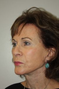 Female Facelift Patient 53 - After - 2 Thumbnail