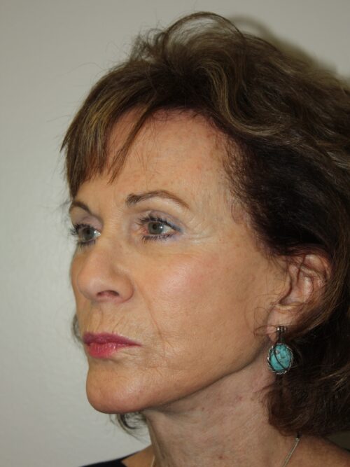 Female Facelift Patient 53 - After - 2