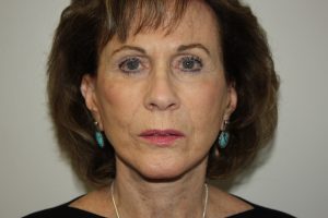 Female Facelift Patient 53 - After - 1 Thumbnail