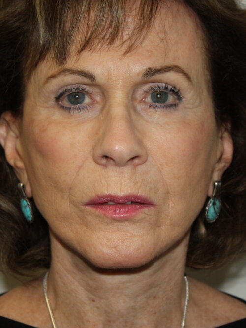 Female Facelift Patient 53 - After - 1