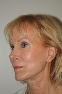 Female Facelift Patient 54 - After - 1 Thumbnail