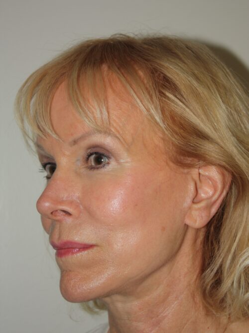 Female Facelift Patient 54 - After - 1