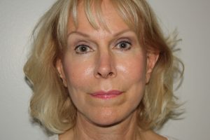 Female Facelift Patient 54 - After - 2 Thumbnail