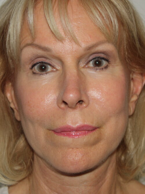 Female Facelift Patient 54 - After - 2