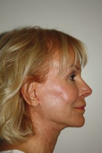 Female Facelift Patient 54 - After - 3 Thumbnail