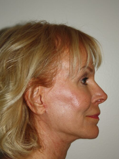 Female Facelift Patient 54 - After - 3