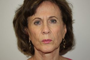 Female Facelift Patient 53 - Before - 1 Thumbnail