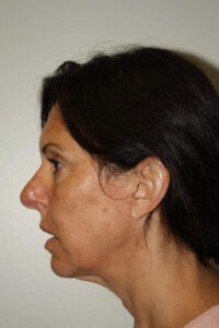 Female Facelift Patient 55 - Before - 3 Thumbnail