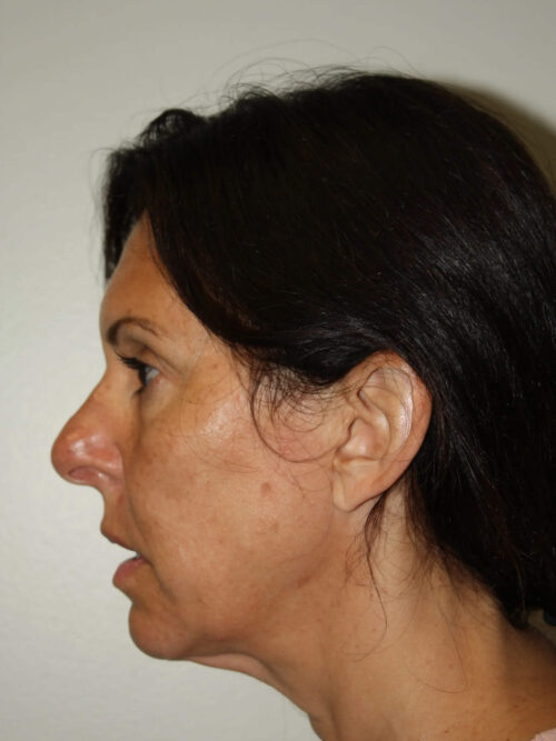 Female Facelift Patient 55 - Before - 3