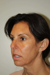 Female Facelift Patient 55 - Before - 1 Thumbnail