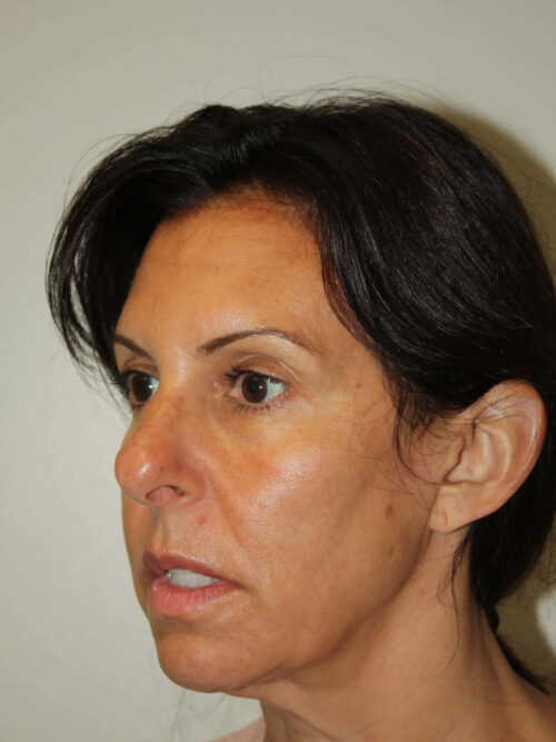 Female Facelift Patient 55 - Before - 1