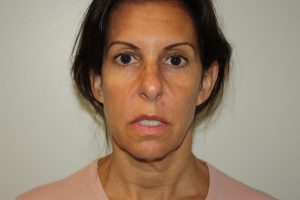 Female Facelift Patient 55 - Before - 2 Thumbnail