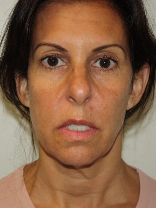 Female Facelift Patient 55 - Before - 2