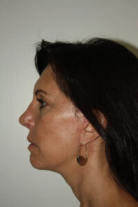 Female Facelift Patient 55 - After - 3 Thumbnail