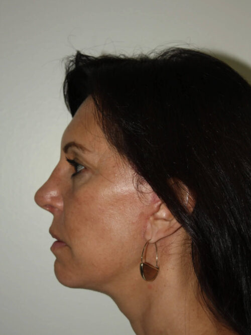 Female Facelift Patient 55 - After - 3