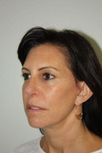 Female Facelift Patient 55 - After - 1 Thumbnail