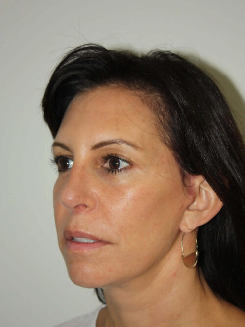 Female Facelift Patient 55 - After - 1