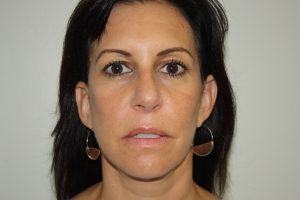 Female Facelift Patient 55 - After - 2 Thumbnail