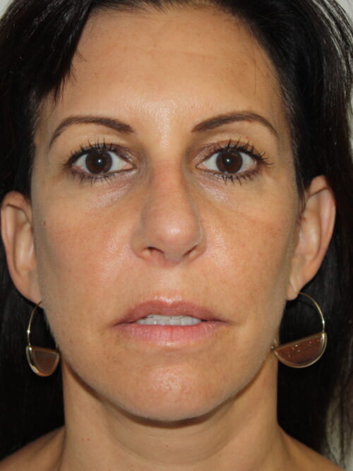 Female Facelift Patient 55 - After - 2