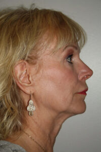 Female Facelift Patient 54 - Before - 3 Thumbnail