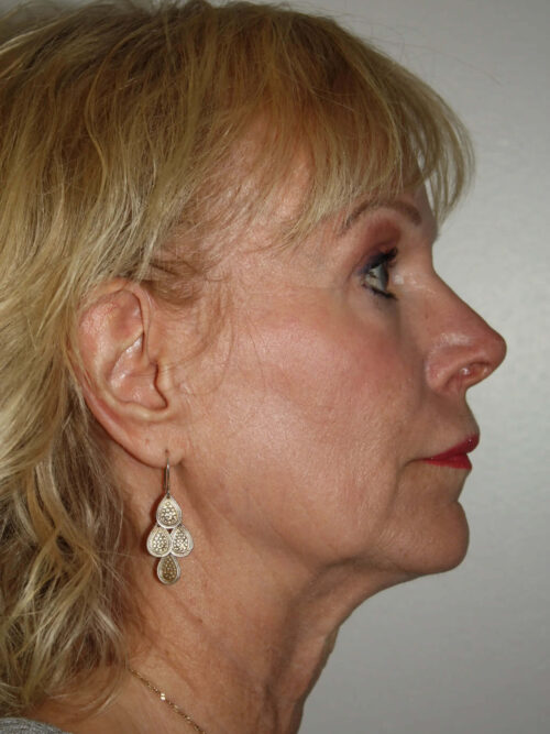 Female Facelift Patient 54 - Before - 3