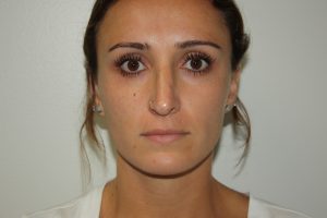 Rhinoplasty Patient 35 - Before - 3 Thumbnail